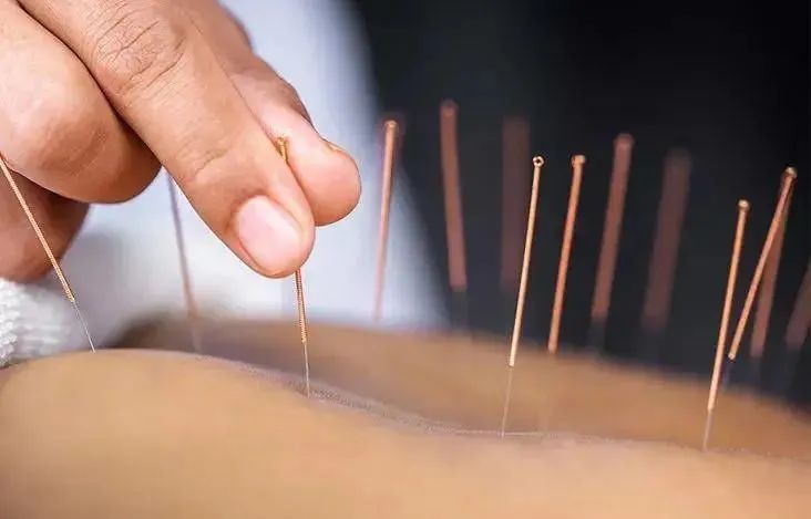 中医穴位埋线：不止减肥，还能同步调理身体！