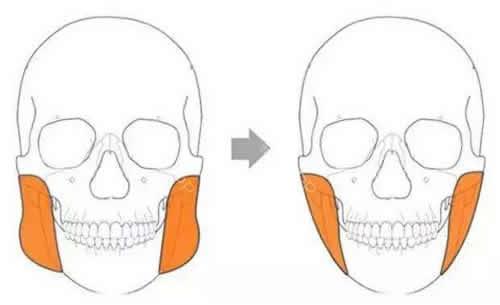 腮帮子大怎么变小,腮帮子大怎么瘦脸