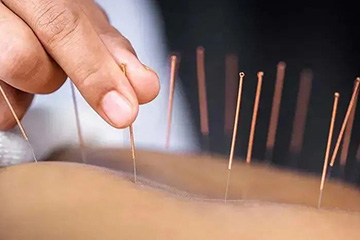 中医穴位埋线：不止减肥，还能同步调理身体！